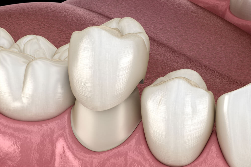 Dental crown premolar tooth assembly process.